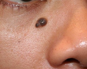 Mole Removal in Dubai